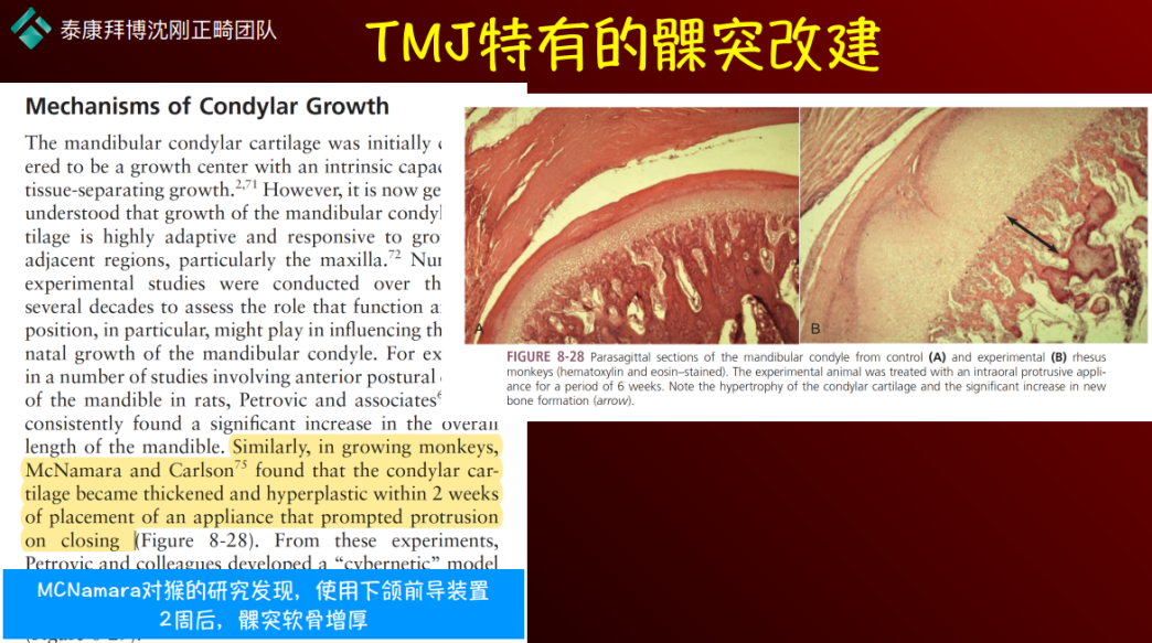 沈刚正畸团队网课精讲（上）丨颌位重建基本原理及实现TMJ改建的相关证据