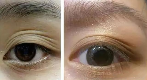 北京好年华大咖问答：双眼皮贴就能实现的效果为什么要做手术？